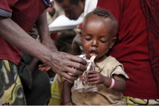 Cativo con desnutrición, en Wolayita (Etiopía)
